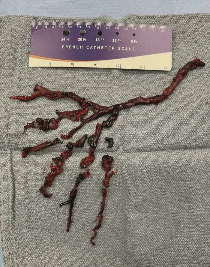Extracción de coágulos tras embolia pulmonar