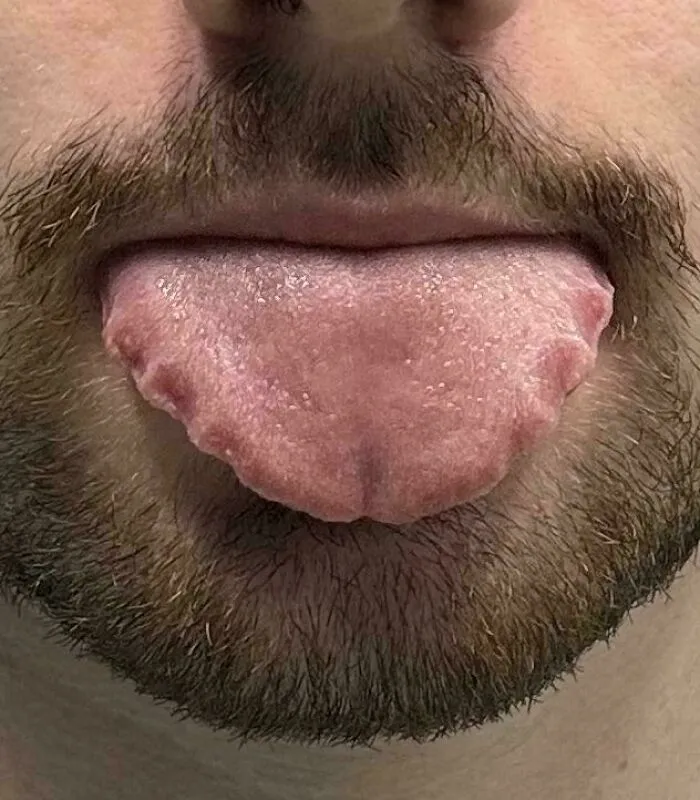 The Shape Of My Tongue Due To Wearing Retainers At Night