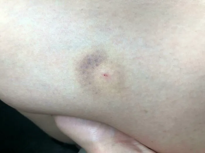 Me picó un mosquito y me chupó la sangre del moretón.