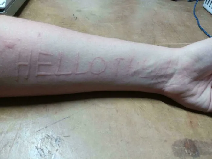 Descubrí que tengo dermatografía