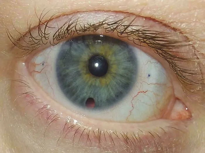 Ojo después de una cirugía de desprendimiento de retina. El cirujano tuvo que cortar el iris, lo que resultó en una pupila fija permanentemente y un agujero en el iris.