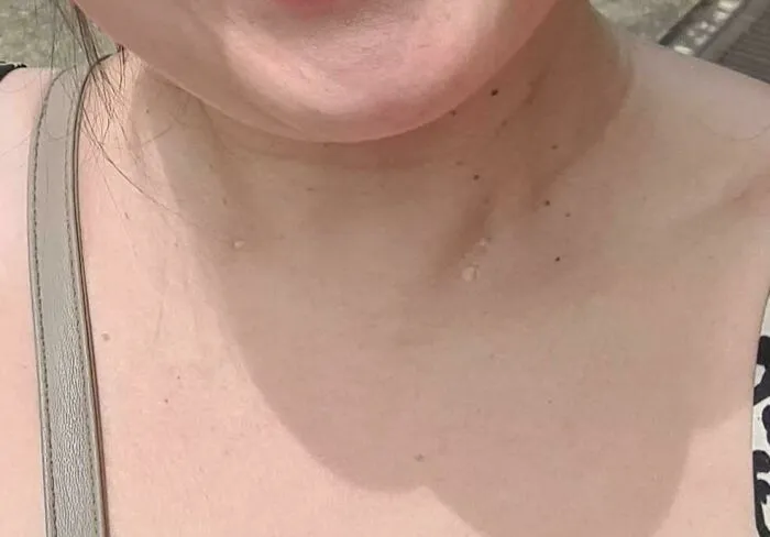 Tengo pequeños orificios del tamaño de la cabeza de un alfiler a cada lado del cuello por donde se filtra líquido sinusal. Creo que se trata de un defecto congénito llamado fístula branquial.