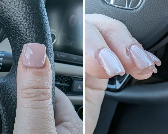 Solo me ha costado 80$ convertir mis pulgares de la mano en pulgares de los pies