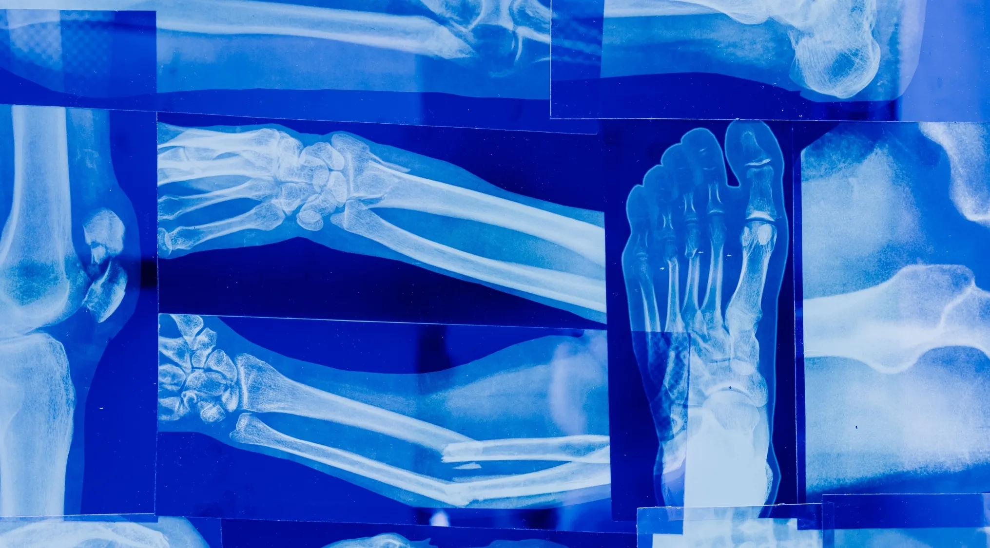 Medical X-rays of human biology, showing bones with a broken bone, used for science and trivia.