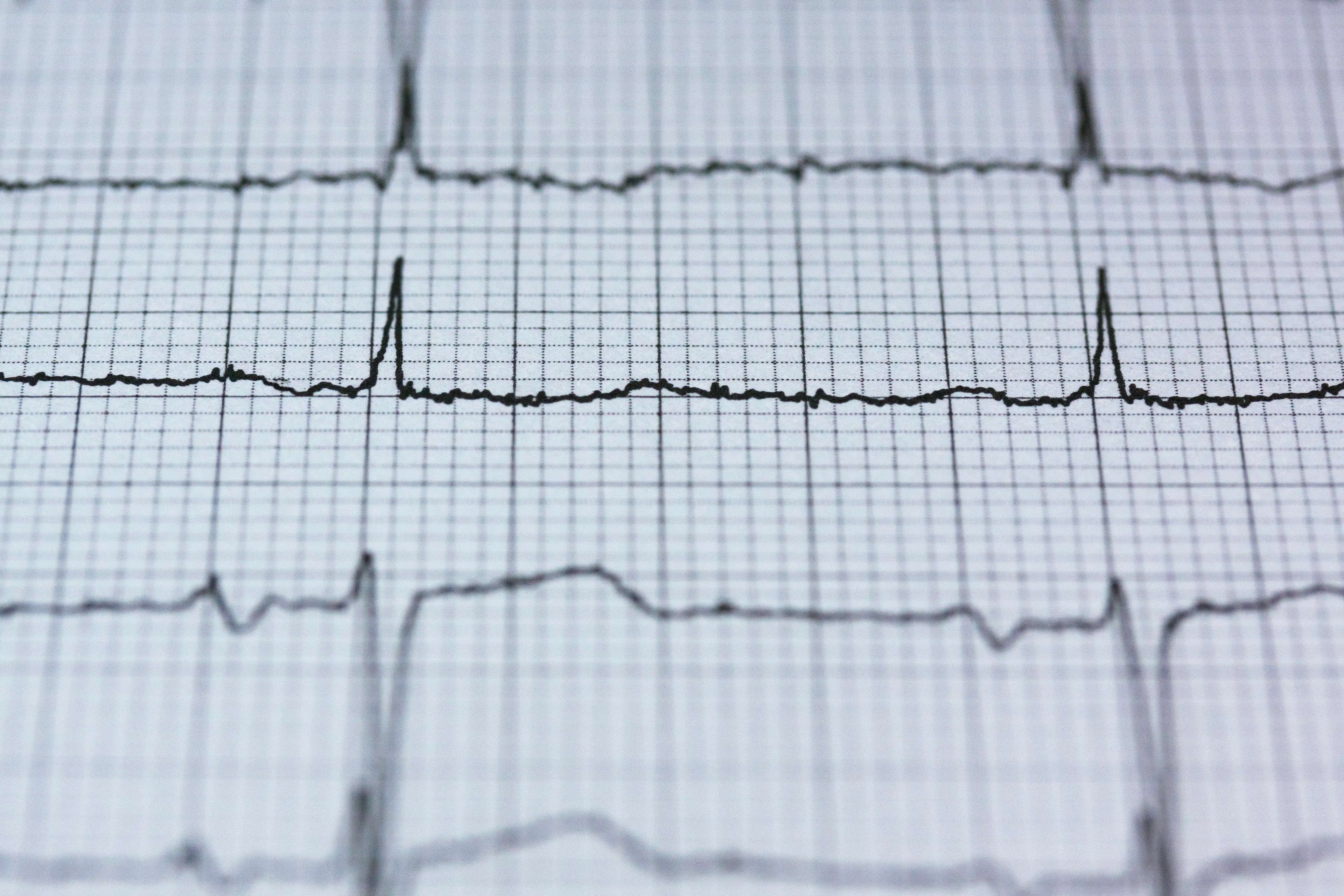 ECG showing heartbeat patterns, related to human biology and medical terms for a fast heartbeat. Science trivia.
