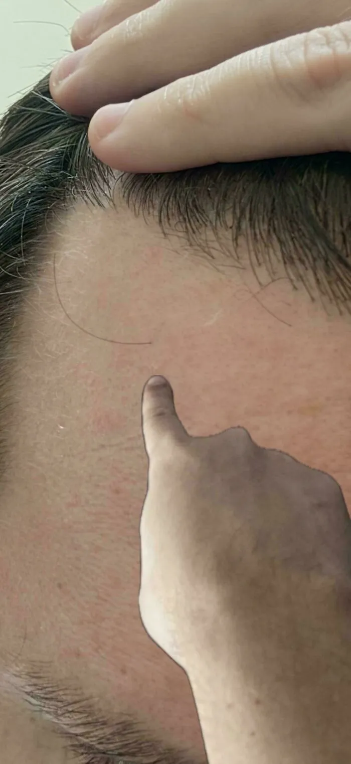 A finger pointing at a tiny, short hair on a person's forehead, from the Not Interesting community.