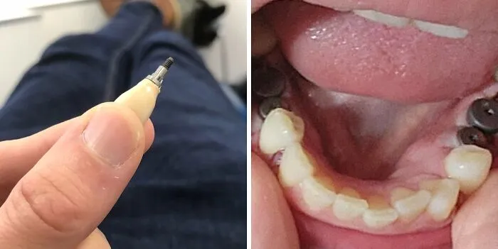 Así es como se ven los implantes dentales.