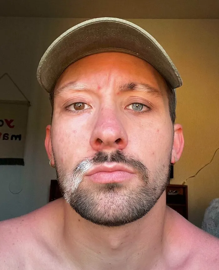 Vitiligo & Heterocromia
