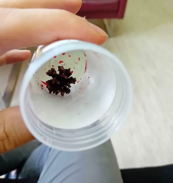 Cálculo renal que se asemeja al virus Covid-19