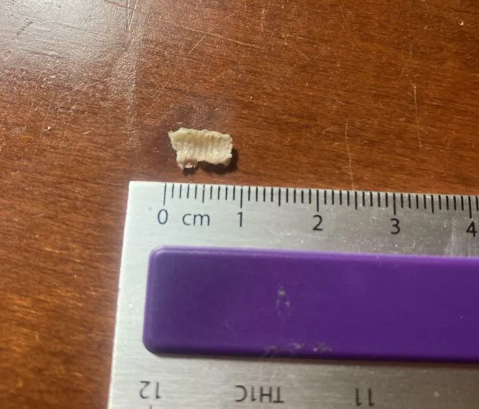 Se me desprendió un trozo de mandíbula; marcas de tornillos por un implante fallido.