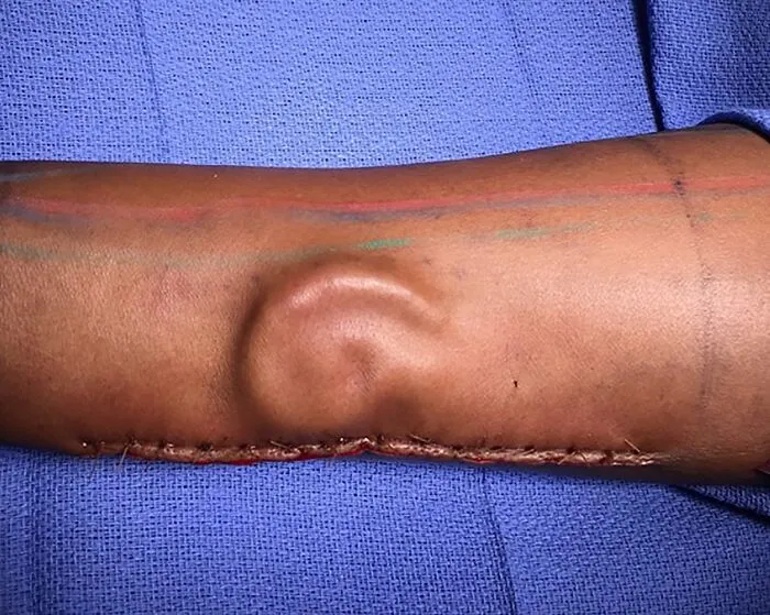 Un médico realiza la primera reconstrucción total de oreja en el Ejército/El Paso para ayudar a una joven soldado a recuperar su vida después de sufrir la pérdida total de su oreja izquierda.