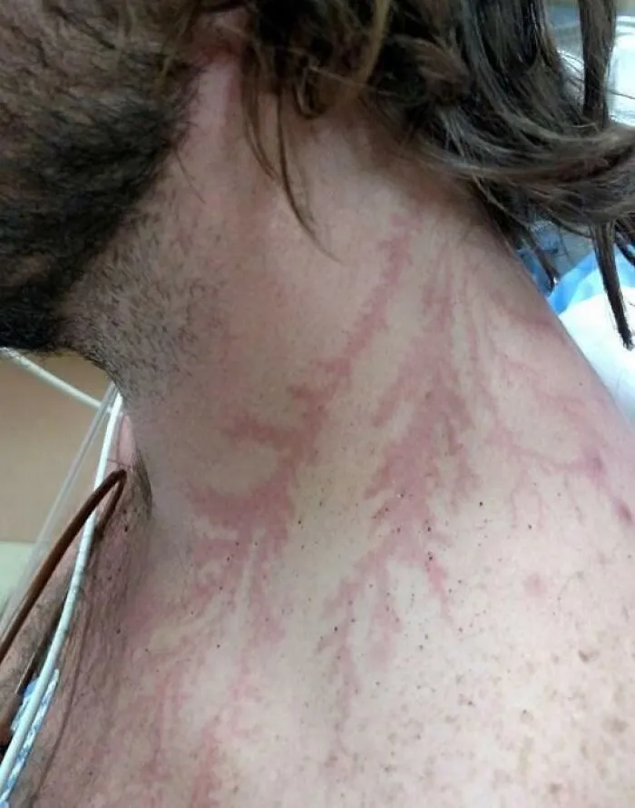 Un hombre de Littleton sobrevive a un rayo que cayó en el monte Bierstadt. El impacto le dejó una marca de Lichtenberg en el cuello.