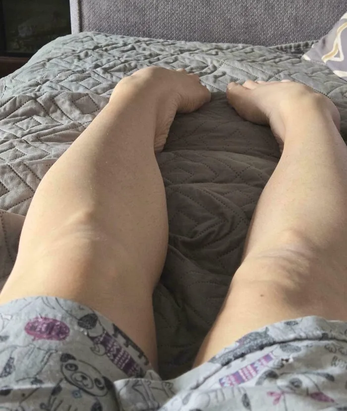 Unique human body quirk of feet rotated unusually backward