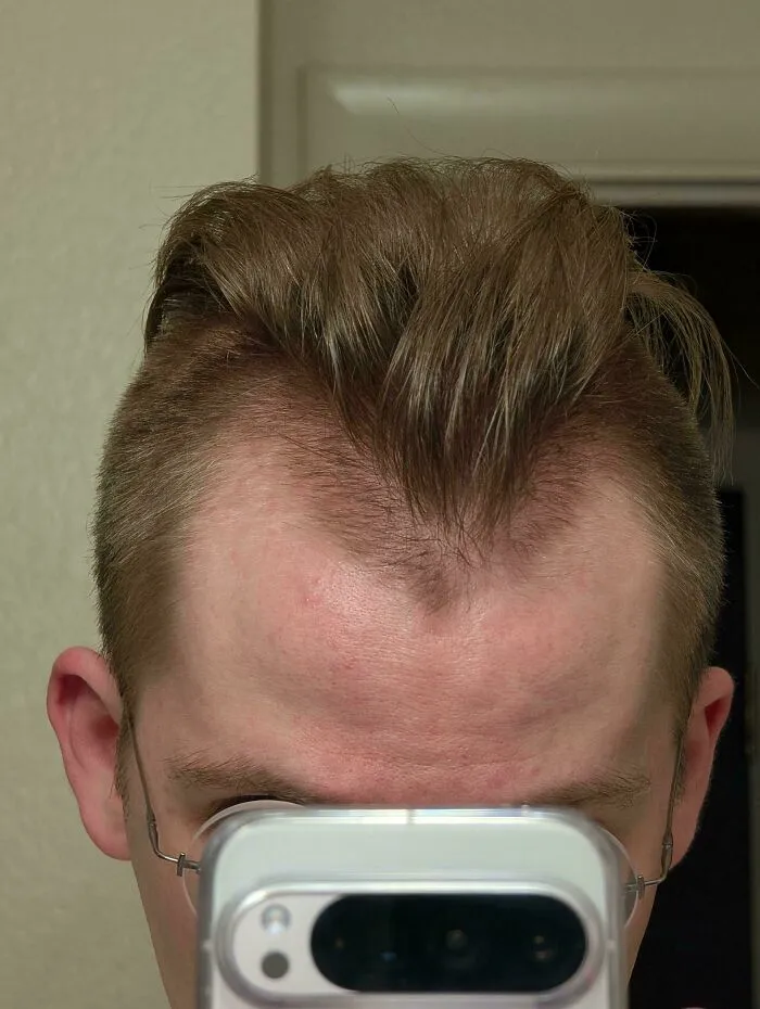 A man with a visibly receding hairline at a hair salon, showcasing a hair salon disaster.