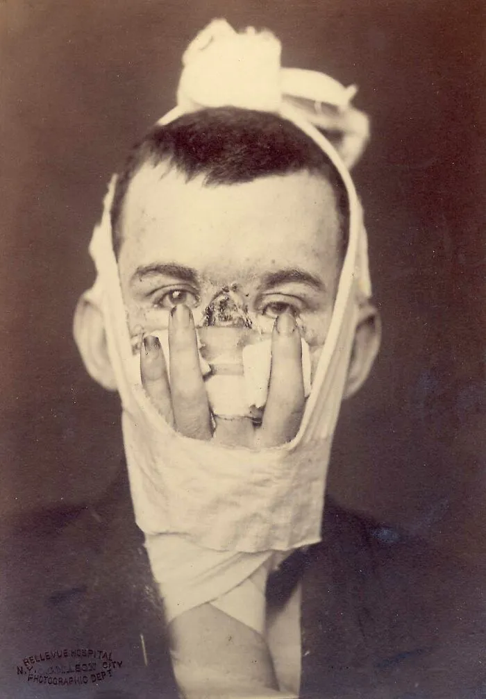 Portrait Of A Man Who Received A Rhinoplasty After Losing His Nose In An Injury. The "Prosthetic" Nose, In The Case, Is One Of His Fingers