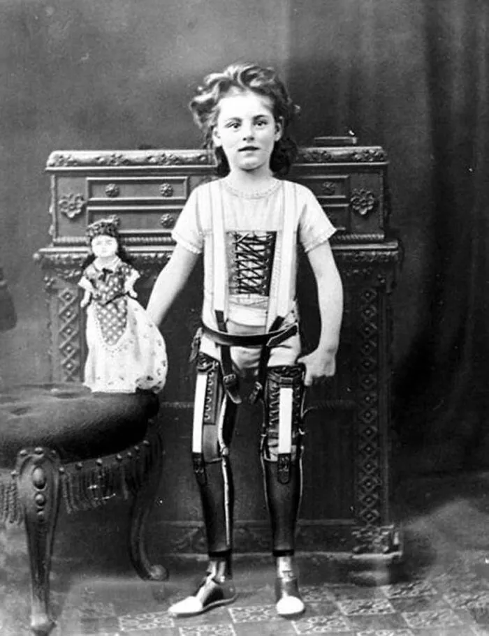 Niña con piernas protésicas (1890)