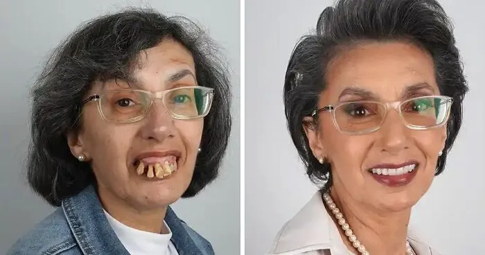 10 Jaw-Dropping Before-And-After Collages Of Women Who Underwent Extensive Smile Makeovers