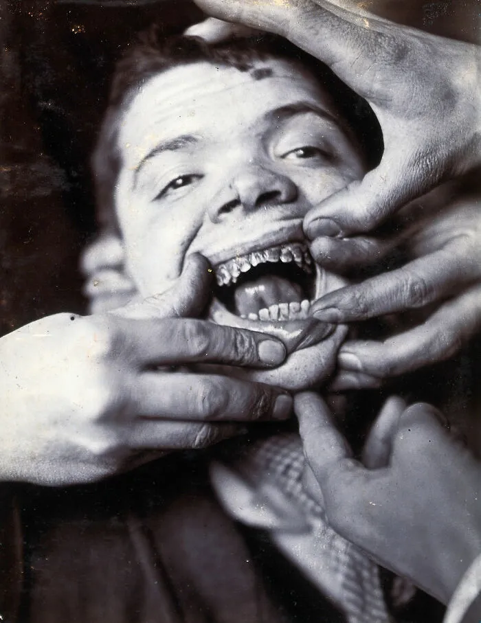 Friern Hospital, London: A Boy With Rotten Teeth. Photograph, 1890/1910