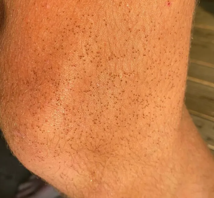 After Going On A Walk, I Was Horrified To Find That I Was Covered With Tiny Ticks. Stay Safe Out There