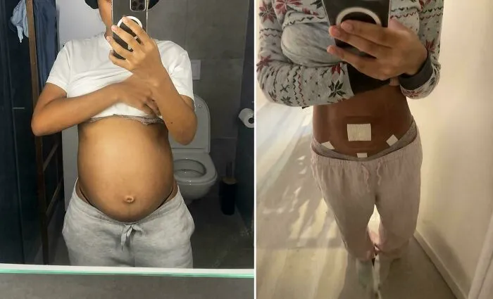 Before & After Removing My 8 Kg Ovarian Cyst
