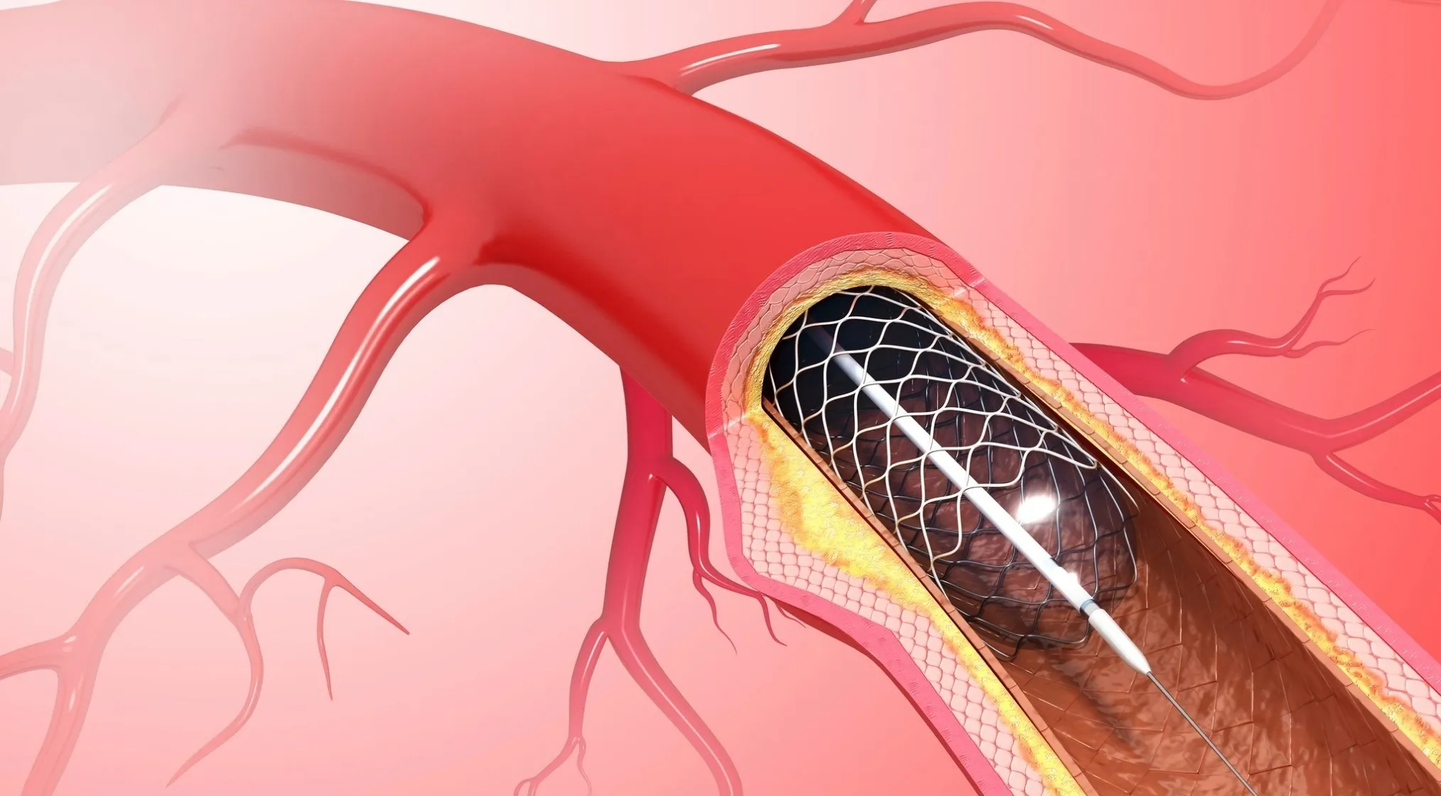 3D illustration of a stent expanding inside a human body artery, addressing the largest artery.