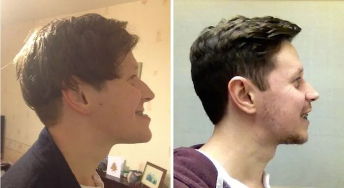 Before & After Double Jaw Surgery