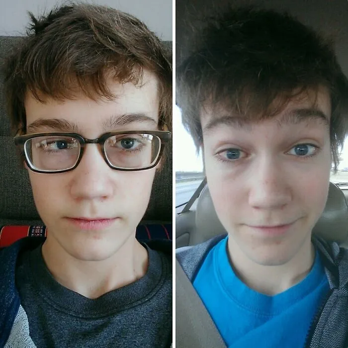 My Crosseye (Strabismus) Surgery Before And After: Update: 3 Weeks Later!