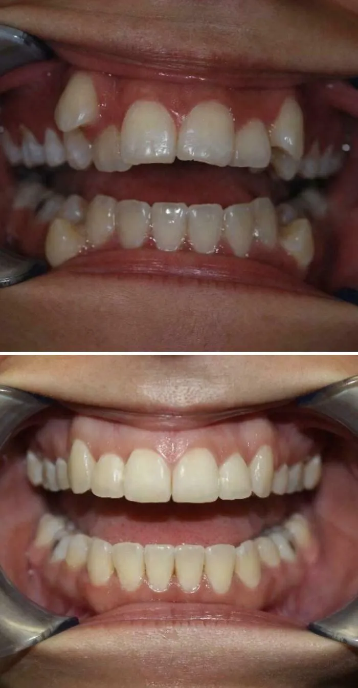 My Teeth, Before And After Braces