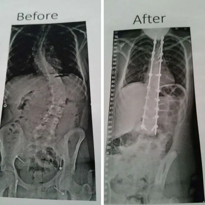 Before & After A Total Spinal Fusion