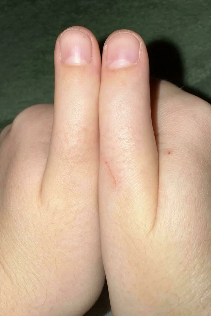 I Have A Birth Defect That Makes Me Unable To Bend My Thumbs