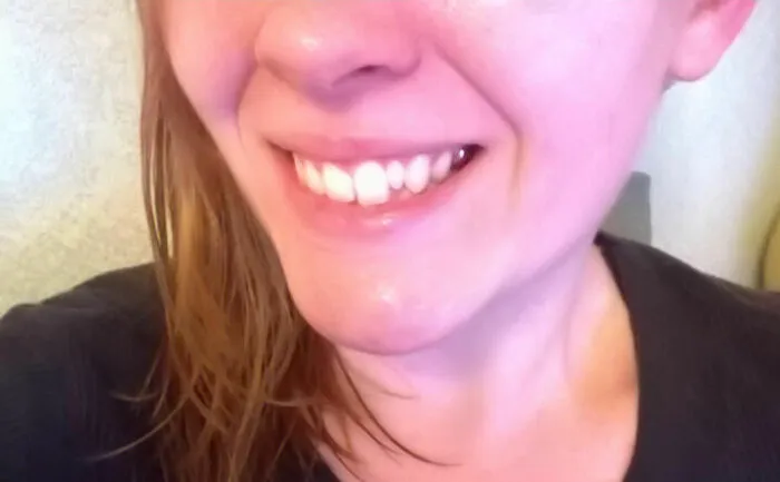 Uno de mis dientes permanentes nunca salió... así que me quedé con un diente de leche para siempre.