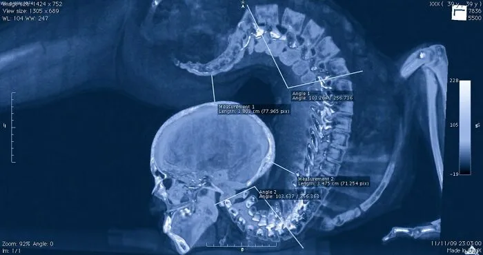 This Is An X-Ray Of A Contortionist Where It's Noticeable That A Significant Part Of The Spine Does Not Bend