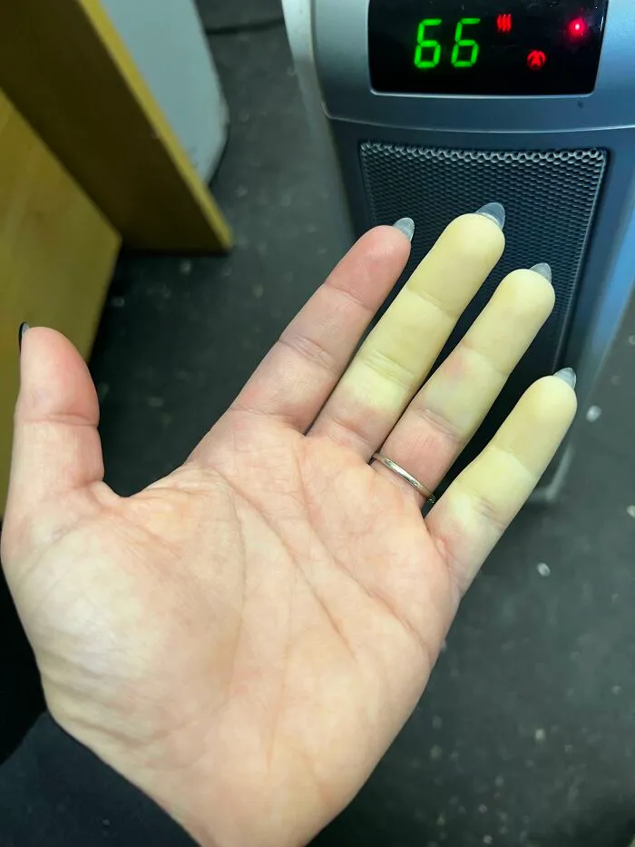 Síndrome de Raynaud (fenómeno) en mi mano esta mañana