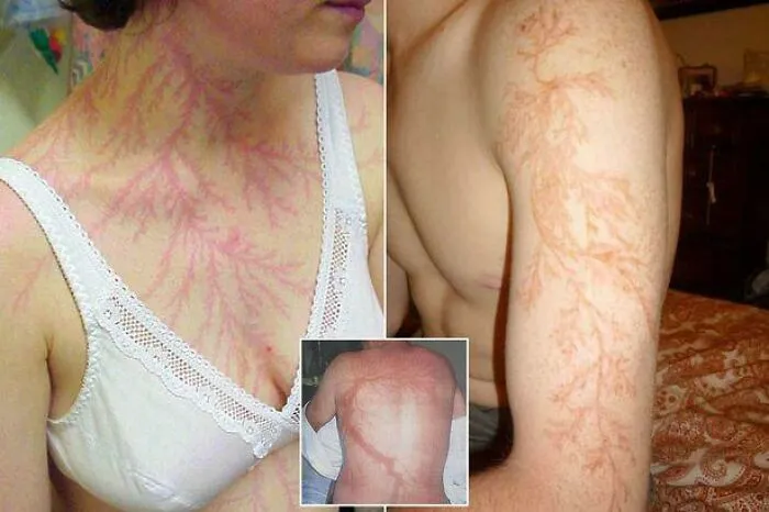 The Scars On The Bodies Of Those Who Survived A Lightning Strike