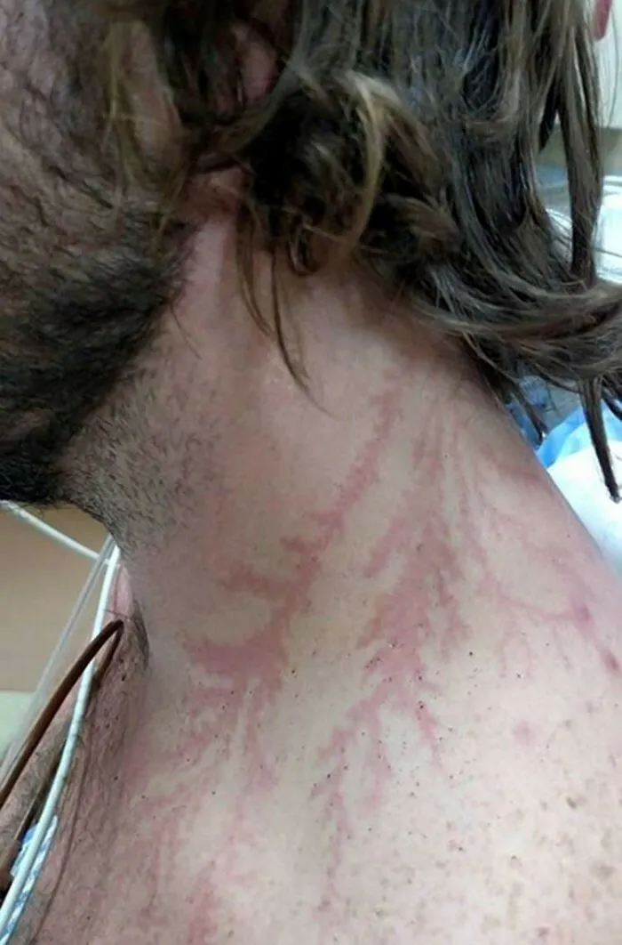 Being Strunk By Lightning Can Leave A Tattoo-Like Marking Or Scar Known As A Lichtenberg Figure
