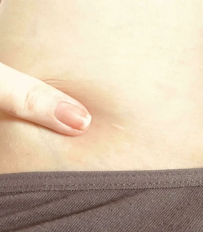 My Friend Has Had Three Life-Saving Heart Surgeries. These Are Her Scars