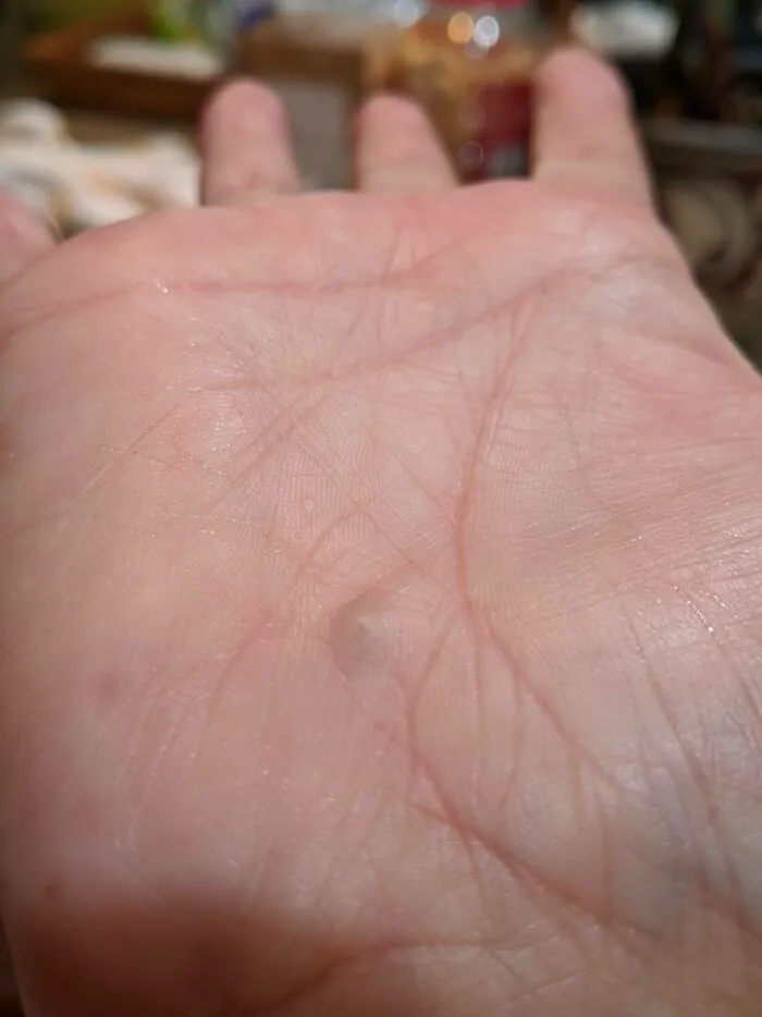 A Rock Working Its Way Out Of My Hand After A Bicycle Accident Over 25 Years Ago