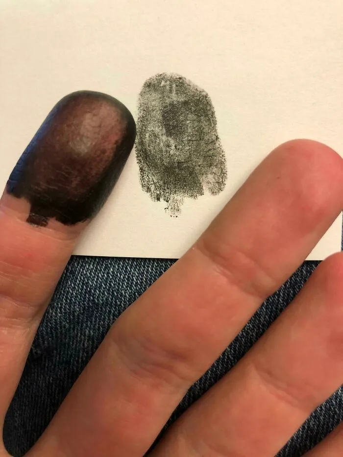 I Was Born Without Finger Or Toe Prints