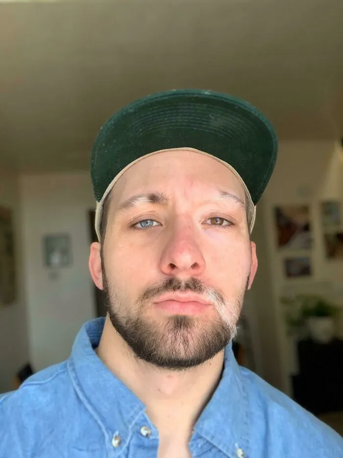 I Have Vitiligo And Heterochromia