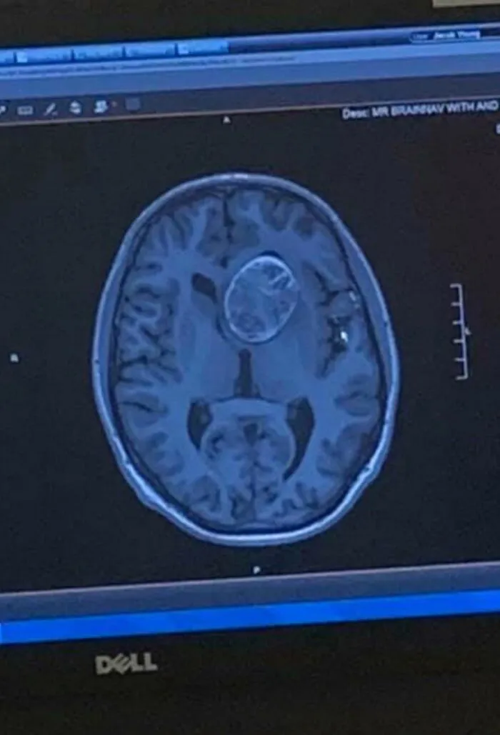 A CT Scan Of My Brain And The 6.2 Cm Dermoid Cyst I Had Surgically Removed In January Of 2019. My Brain Somehow Managed To Grow Around It Without Causing Me To Become Mentally Or Physically Disabled For 22 Years