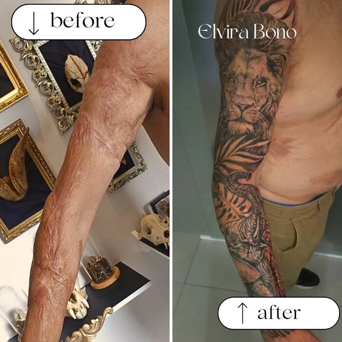 Tattoo In A Scar Of Burn Suffered In Childhood