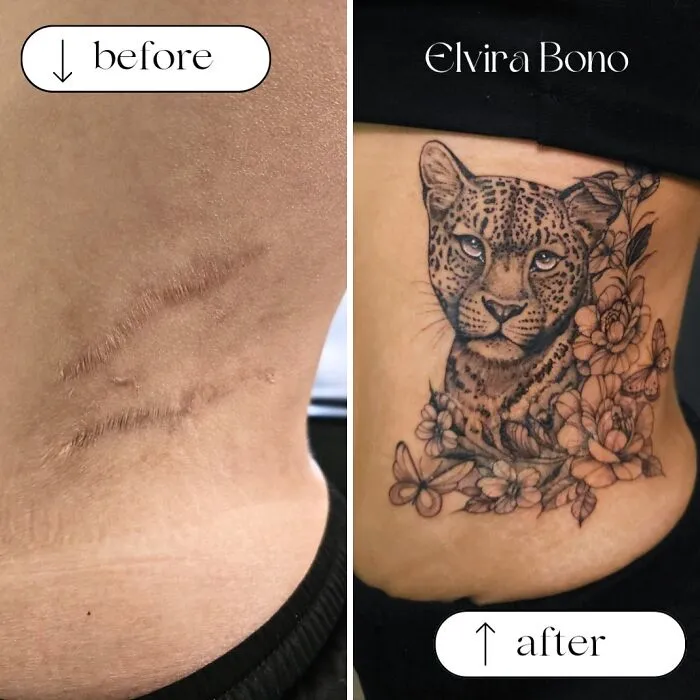 Tattooing In Surgical Scars
