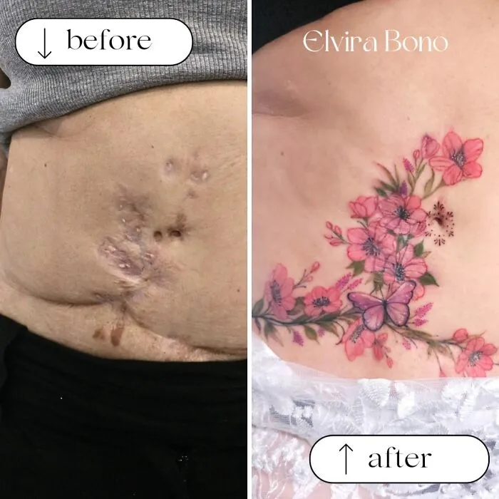 Tattoo In Scar After Surgical Complication