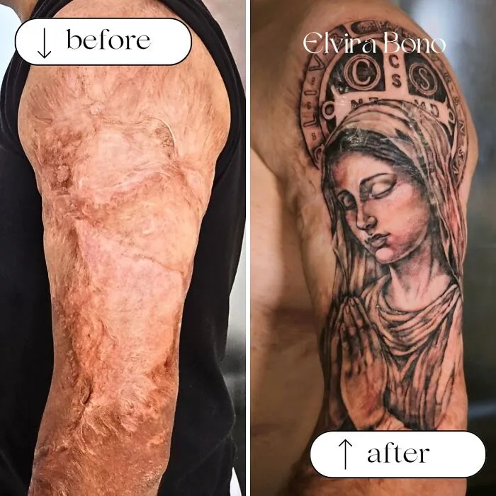 Tattoo On Burn Scar By Accident Suffered In Childhood
