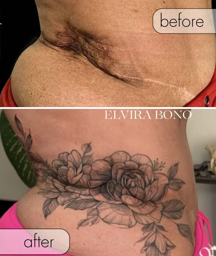 Tattoo In Deep Scar Due To Surgical Complication