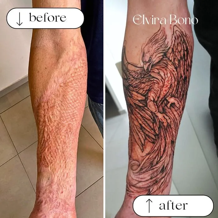 Tattoo In A Scar Of Graft Burn After Traffic Accident