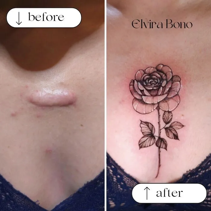 Tattoo On Keloid Scar