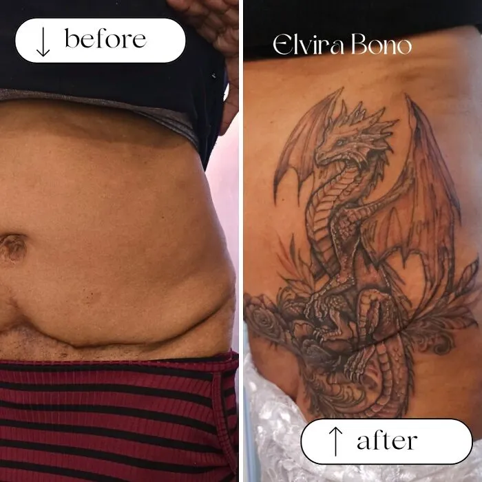 Tattoo In Abdominoplasty Scar
