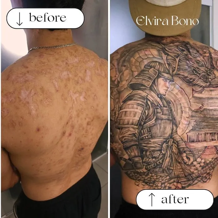 Tattoo On Acne Scars
