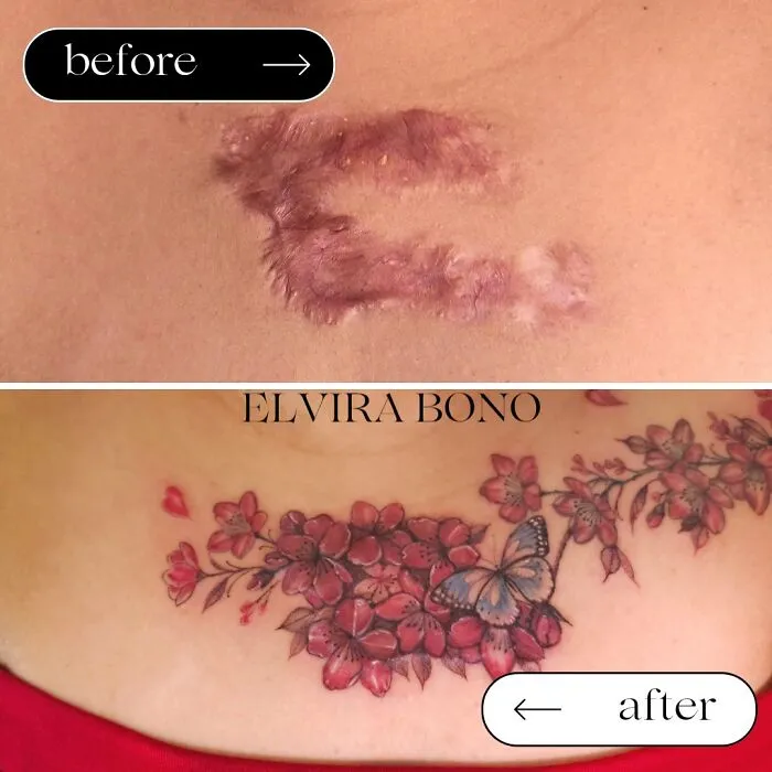 Tattoo On Keloid Scar For Acne